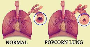 Popcorn-Lung